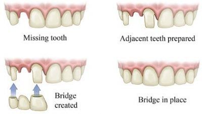 Dental bridge diagram